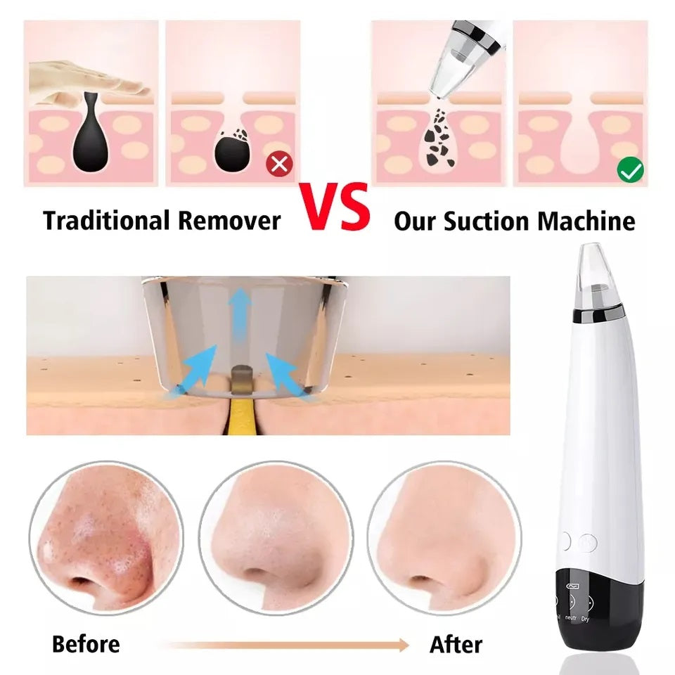 5 in 1 Electric Blackhead Acne Oil Remover
